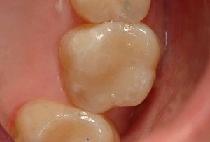 dental filling, tooth restoration