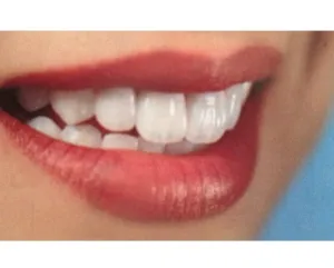 womant smiling with dental crowns