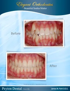 Before and after orthodontic treatment