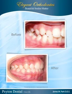 Before and after elegant orthodontics