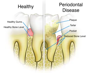 Diagram of teeth with and without periodontal disease