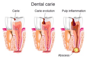 Diagram of three stages of tooth decay