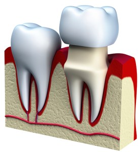 Digital illustration of a tooth with a dental crown