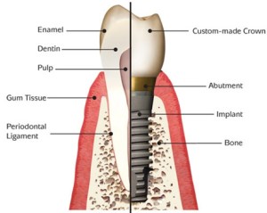 Diagram of a natural tooth side-by-side with a dental implant
