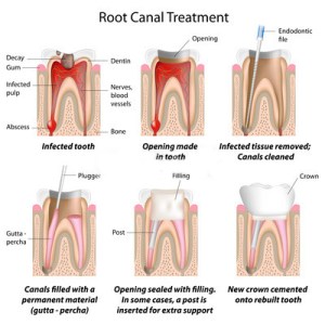 Diagram of the different stages of root canal treatment