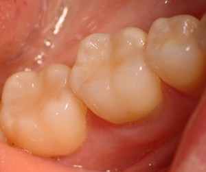 Teeth with dental fillings