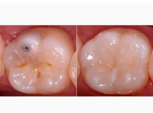 Tooth before and after Teeth Color Cosmetic Restorations