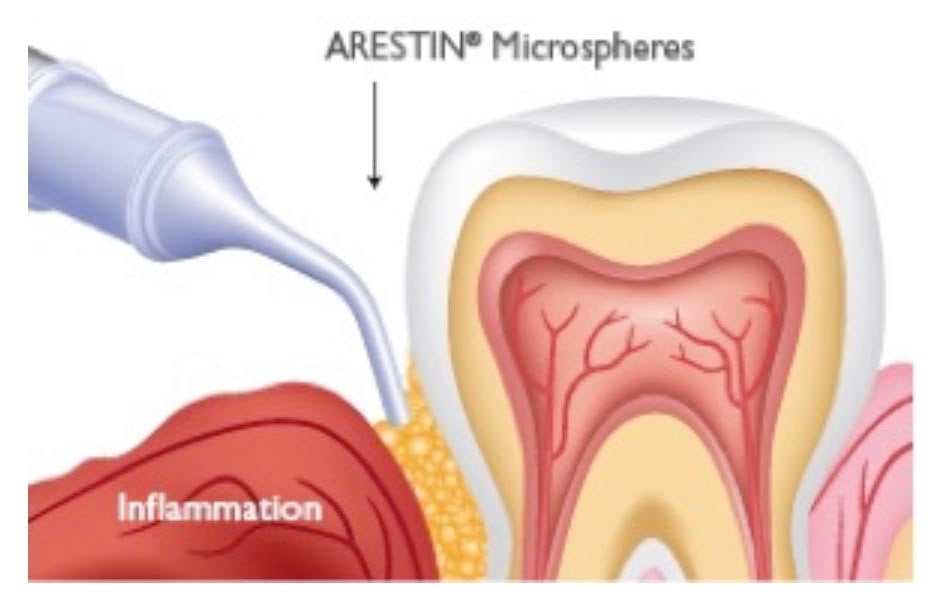Diagram of using Arestin killing bacteria around a tooth