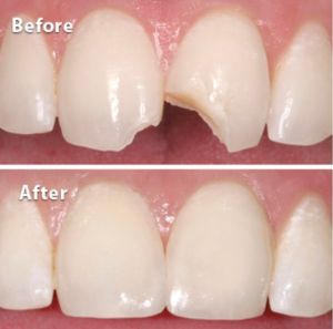 Before and after photo of a broken tooth fixed with a composite restoration
