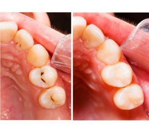 Before and after photo tooth decay fixed with a composite restoration