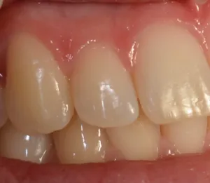 Healthy gums from a 25 year old patient
