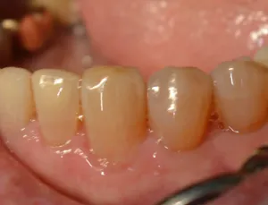 Healthy gums from a 92 year old patient