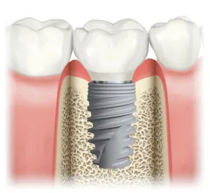 Diagram of Nobel Biocare Dental Implant and Crown Restoration
