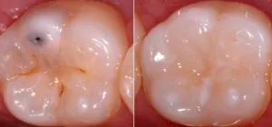 Before and After photo of a tooth fixed with dental sealant